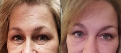 45-54 year old woman treated with Secret RF - This is an unedited photo of an actual patient before and after her first Secret RF treatment. Note: The only thing done was 1 treatment of Secret RF! No Botox or fillers ...and No makeup!!! Actual Before treatment and the next day after!!! 30 Minutes and two passes done at 3mm and 2mm.