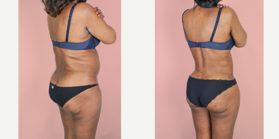 55-64 year old woman treated with Tumescent Vaser Liposuction Revision - This patient had prior liposuction by another surgeon but this left her with residual fat and an unsatisfying result. She is shown here 3 months post-op from 360 Lipo suction. She was finally able to achieve a cinched waistline and smooth contour.