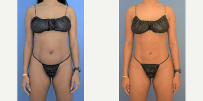 25-34 year old woman treated with Brazilian Butt Lift, Liposculpture, Liposuction - 6-months following BBL, 360 liposuction with liposculpture, and arms liposuction. Natural and symmetric result was the goal.