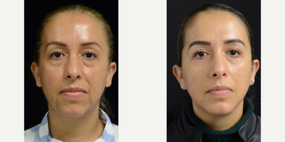 35-44 year old woman treated with Lifestyle Lift - 42 year old was not happy with the way she was aging. She was found to have deficient bone structure. She had upper and lower eyelid surgery, a face and neck lift with smart lipo and a chin Implant. All procedures were performed with oral sedation and local anesthesia. Although this was not performed at a Lifestyle Lift facility, it was the procedure that I developed over many years while working there.