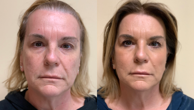 Liquid Facelift - Liquid Face Lift with PDO Threads, Botox, and Fillers