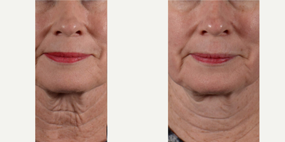 55-64 year old woman treated with Morpheus8 - 1 Treatment of Morpheus 8 on lower face and neck