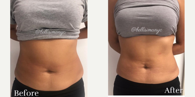 25-34 year old woman treated with BodyFX - Results are after 4 BodyFX mega-sessions