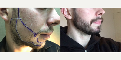 25-34 year old man treated with FUE Hair Transplant - Beard Transplant performed by Dr ARSLANGrafts Number: 2700Result: 5 months post-opMethod: Micro FUE /Extraction: Punch 0,75mm/Incision with special sapphire blades
