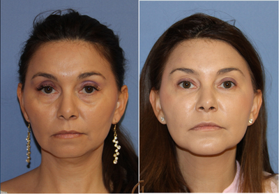 Fat transfer performed under local anesthesia - A fat transfer, also known as fat grafting or fat injections, is performed by removing unwanted fat from the patient's body. This is done utilizing liposuction and is usually performed on the patient's stomach, back, flanks, thighs and other common areas where stubborn fat is stored by the body. The patient's fat is then purified and used as an injectible filler to correct volume loss due to aging and/or weight loss. PRP (Platelet Rich Plasma) can be mixed with the patient's fat to increase its survival rate after the injection has been performed. This patient received fat grafting to correct volume loss due to aging, her biggest concern was under her eyes. She looked hollowed out, had tired eyes and was starting to form under eye bags. Dr. Kevin Sadati performed her procedure in less than one hour. Everything was performed in office under local anesthesia and twilight sedation, no general anesthesia was needed to create a comfortable experience for the patient. Recovery went smoothly with swelling lasting about a week after surgery.