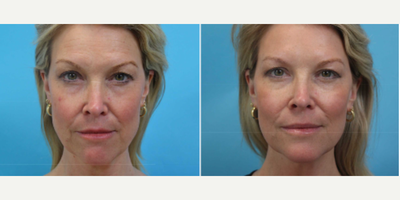 Woman treated with Botox, Injectables - Woman treated with Botox, Injectables
