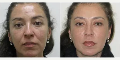 Woman treated with Botox, Injectables - Woman treated with Botox, Injectables