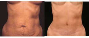Mommy Makeover Tummy Tuck - 
	Skin Only Abdominoplasty
