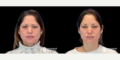35-44 year old woman treated with Dysport - The patient is a 38-year-old female who had concerns about fine lines and wrinkles on her upper face. Dr. Chiang used wrinkle relaxer (Dysport) to treat the forehead, glabella, crows feet, and lower brows to address these concerns. The after results are 2 weeks post-treatment.