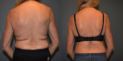 55-64 year old woman treated with Body Lift - This 58 year old woman weighs 124 pounds and is 5'6 tall. She was bothered by the loose skin / rolls on her back. She under went a Bra Line Back Lift. The results are shown 9 months after surgery. Note that the scar is easily hidden under her bra.
