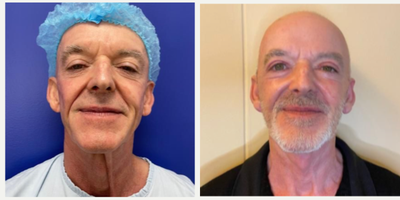 55-64 year old man treated with Facelift Revision, Neck Lift, Facelift, MACS Facelift, SMAS Facelift - In this case, we perform a revision facelift, achieving a fresh and natural appearance.