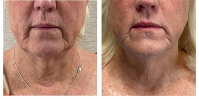 65-74 year old woman treated with Opus Plasma - Opus Plasma for Face andNeck after 1 treatment