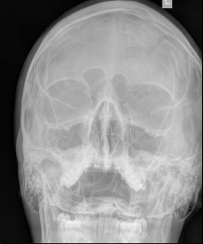 X Images Ray Sinusitis