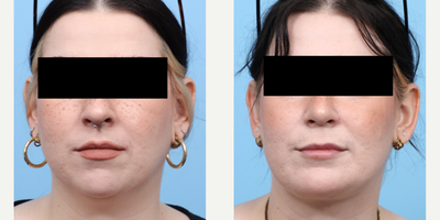 25-34 year old woman treated with Chin Liposuction, Chin Implant - This 30-year-old patient wanted more definition in her lower face to balance her strong facial features. For a more permanent and dramatic solution, Dr. Wise performed submental liposuction to remove excess fat, in addition to a chin implant. She has a completely harmonious, natural-looking result shown 3 months post-op.
