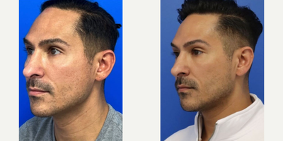 25-34 year old woman treated with Microneedling, Skin Rejuvenation - After 4 sessions of PRP with scar subcisions by PA Steve.