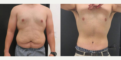 Male Tummy Tuck - Patient underwent abdominoplasty with liposuction to the hips and flanks.