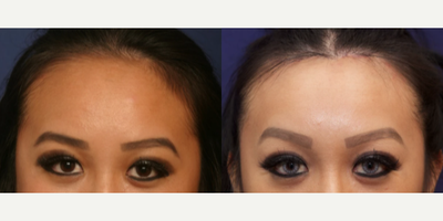 Woman treated with Brow Lift - Woman treated with Brow Lift
