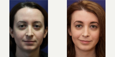 Woman treated with MTF Facial Feminization Surgery - Woman treated with MTF Facial Feminization Surgery. She underwent hairline forehead lift, hairline lowering, orbital bony contouring, rhinoplasty revision with cartilage grafts, subnasal lip lift with fat augmentation, chin implant, chin contouring, thyroid cartilage shave, and soft tissue to nasolabial folds.