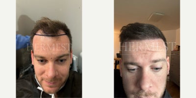 25-34 year old man treated with DHI Hair Transplant - 12-month transformation of our patient from Germany after 2,549 grafts using the DHI Method.