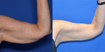 65-74 year old woman treated with Morpheus8 - 70 year old female shown 6 months after BodyTite lipo to her arms combined with Morpheus8 RF microneedling.