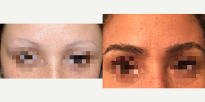 35-44 year old woman treated with Eyebrow Transplant - Before and after 800 grafts to eyebrows