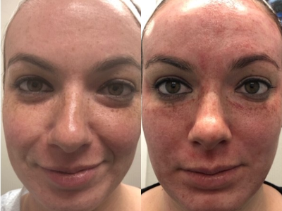 25-34 year old woman treated with Vampire Facial - 25-34 year old woman treated with Vampire Facial