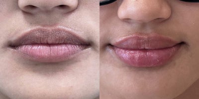 25-34 year old woman treated with Restylane Defyne - This 27-year-old patient enhanced her lips with one syringe of Defyne filler. In the before photo, her lips have a beautiful natural shape but appear less full. The after photo reveals a subtle yet impactful improvement, with added volume and a smoother, more hydrated look. The result maintains a natural appearance while enhancing her features, demonstrating how Defyne filler can deliver beautifully balanced, refreshed lips.