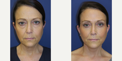 47 year old woman treated with facelift, blepharoplasties, and fat grafts to face - 47 year-old female seen 8 months after upper and lower blepharoplasties, facelift, and fat grafts from abdomen to face.