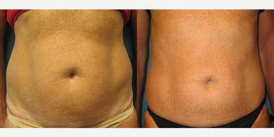 Woman treated with Thermage - Woman treated with Thermage to abdomen