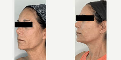 Woman treated with Morpheus8, Lumecca - See the incredible results of 2 Lumecca sessions & Morpheus8.