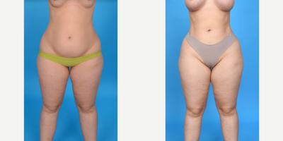 35-44 year old woman treated with Liposculpture - VASER Liposuction from abdomen, flanks: Lipo 360