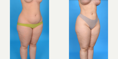 35-44 year old woman treated with Breast Fat Transfer - Breast Fat Transfer: 600cc/breast. Liposuction from abdomen, flanks: Lipo 360
