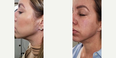 45-54 year old man treated with Thread Lift, Radiesse, NovaThreads, Skin Rejuvenation - Neck Rejuvenation combining PDO threads and Radiesse Collection