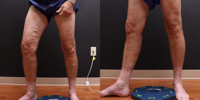 55-64 year old man treated with EVLT, Sclerotherapy - Patient had two EVLTs on greater saphenous veins, followed by Sclerotherapy treatments.