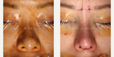 35-44 year old woman treated with DCF Rhinoplasty, Asian Rhinoplasty, Revision Rhinoplasty - 35-44-year-old woman treated with revision DCF rhinoplasty. Patient originally had undergone primary rhinoplasty approximately 15 years ago. Since her initial surgery, she has felt that her nose has changed considerably as the tip projection has dropped giving her profile a suboptimal appearance. She was seeking a more conservative change.  The nasal bridge implant was removed and replaced with a DCF graft to minimize infection risk. Nasal tip was refined utilizing a combination of septal extension graft as well as nasal tip grafts. Patient was able to achieve the natural change that she was seeking in her nose.