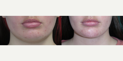Woman treated with Chin Implant - This patient came to us because she wanted to reduce the fullness in her neck and add more projection to her chin. This was accomplished by neck liposuction as well as a silicone chin implant.