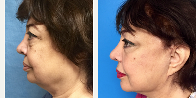 65-74 year old woman treated with Facelift and Lower Blepharoplasty - 65 year old woman treated with Facelift and Lower Blepharoplasty