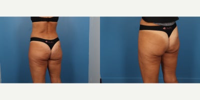 45-54 year old woman treated with Aveli - Aveli is a minimally invasive, FDA-cleared treatment for cellulite that targets the fibrous bands (septa) beneath the skin that cause dimpling. It works by precisely releasing these bands, allowing the skin to smooth out naturally. Aveli is known for providing long-lasting results with minimal downtime, and it offers a significant reduction in cellulite appearance after just one treatment.