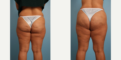 25-34 year old woman treated with Cellfina - A 31-year-old woman before and after a single treatment with Cellfina for cellulite reduction of her buttocks, posterior and lateral thighs by Andrew Lyos M.D., FACS.