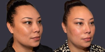 35-44 year old woman treated with Eyelid Surgery, Chemical Peel, TCA Peel - This 36 year old presented requesting improvement in her puffy lower eyelids. She had a lower eyelid lift with a hidden incision inside the eyelid, (trans-conjunctival lower blepharoplasty), and TCA chemical peel of the skin around the eyes.