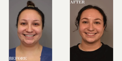 Woman treated with Chin Liposuction - Woman treated with Chin/Neck Liposuction as well as Cheek Liposuction to reduce fullness in both neck and lower cheeks, shown 3 months post op. Pre-op, patient struggled with a round and bottom heavy face throughout her life.