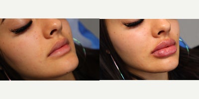 25-34 year old woman treated with Juvederm - Lip filler