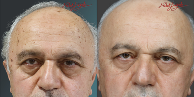 65-74 Years Old Man Treated with Mole Removal - In general terms, the final state of our male patient, whose moles on the face and forehead areas were removed; it is available in the appendix.