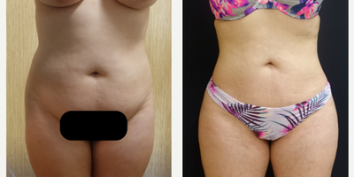 35-44 year old woman treated with Butt Lift - The patient underwent a Brazilian Butt Lift (butt augmentation with fat transfer). The combination of the liposculpting and fat transfer to her butt and hips enhance her butt and give her an hourglass figure. The pictures show her results six months after her surgery.