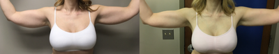 45-54 year old woman treated with Liposculpture - Patient had Body Jet lipo to her arms