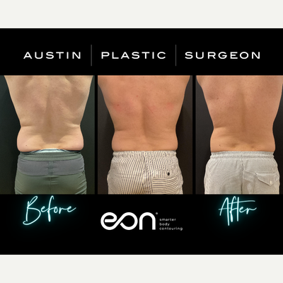 Eon Treatment Before, after 1st treatment, after 2nd treatment - Eon Treatment Before, after 1st treatment, after 2nd treatment