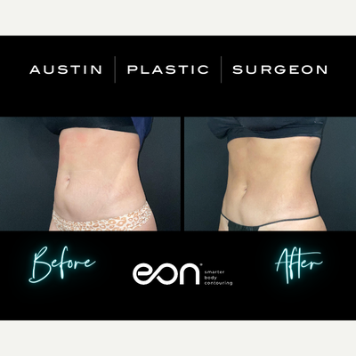 25-34 year old woman treated with Eon - 25-34 year old woman treated with Eon In Austin TX & San Antonio TX