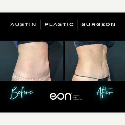 25-34 year old woman treated with Eon - 25-34 year old woman treated with Eon In Austin TX & San Antonio TX