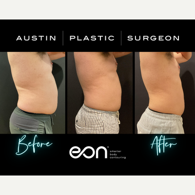 Eon Treatment Before, after 1st treatment, after 2nd treatment - Eon Treatment Before, after 1st treatment, after 2nd treatment