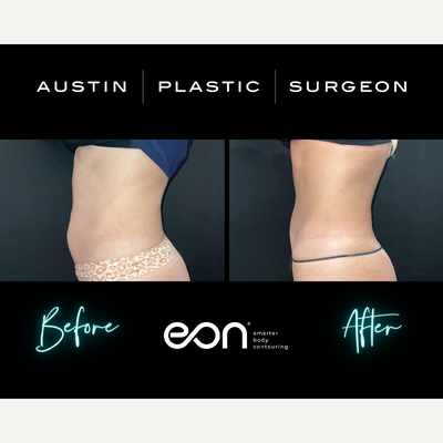 25-34 year old woman treated with Eon - 25-34 year old woman treated with Eon In Austin TX & San Antonio TX